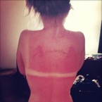 Kelly Osbourne reveals painful sunburn & red tan lines